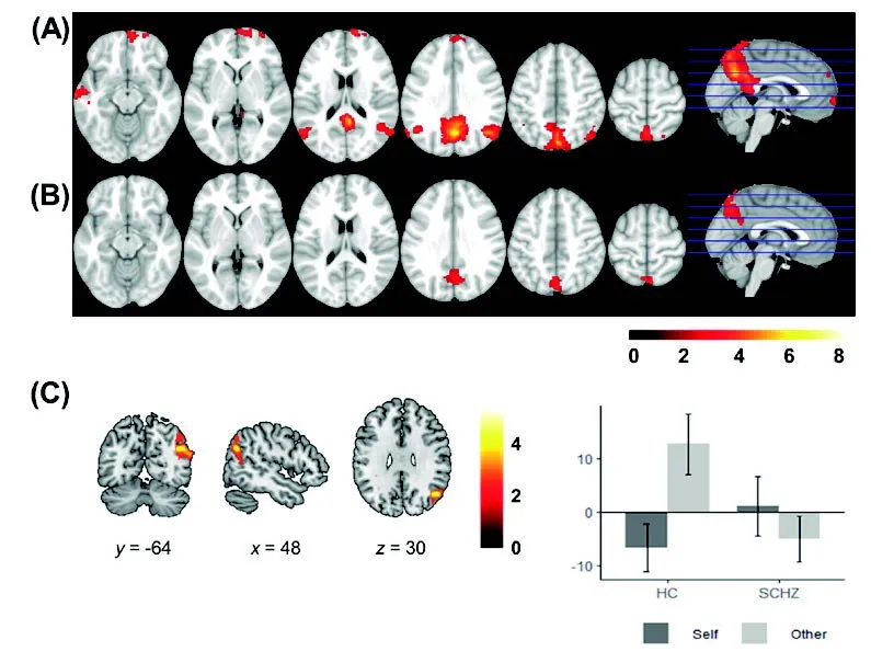 Estudio Correlatos neuronales de la percepción del ‘yo’ y del ‘otro’ en la esquizofrenia